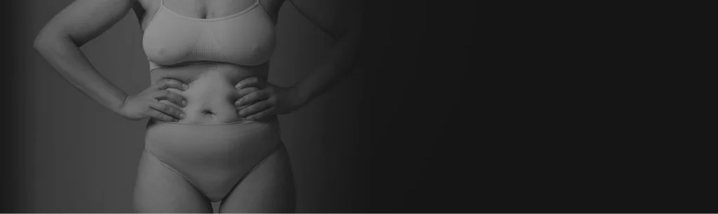 Paciente após abdominoplastia clássica