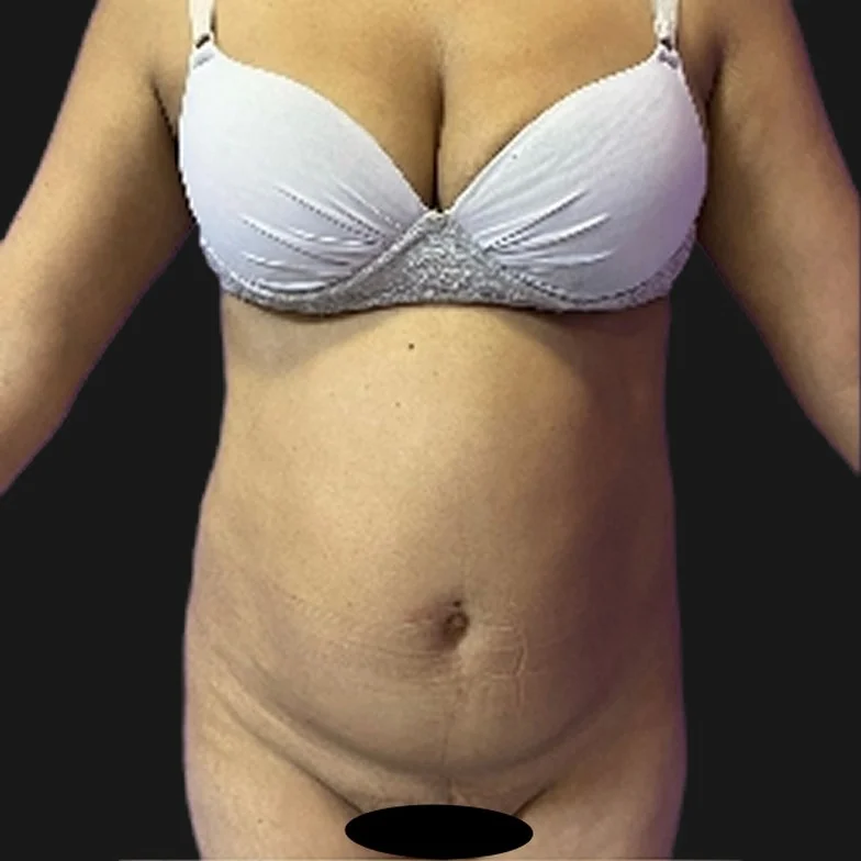 Resultado de abdominoplastia clássica — antes
