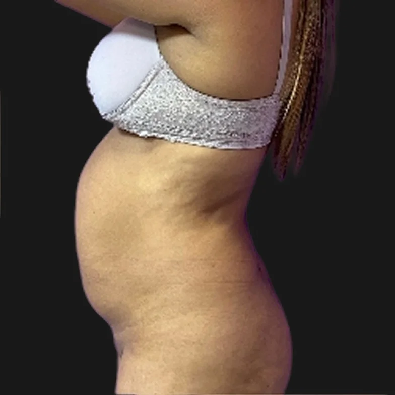 Resultado de abdominoplastia clássica — antes