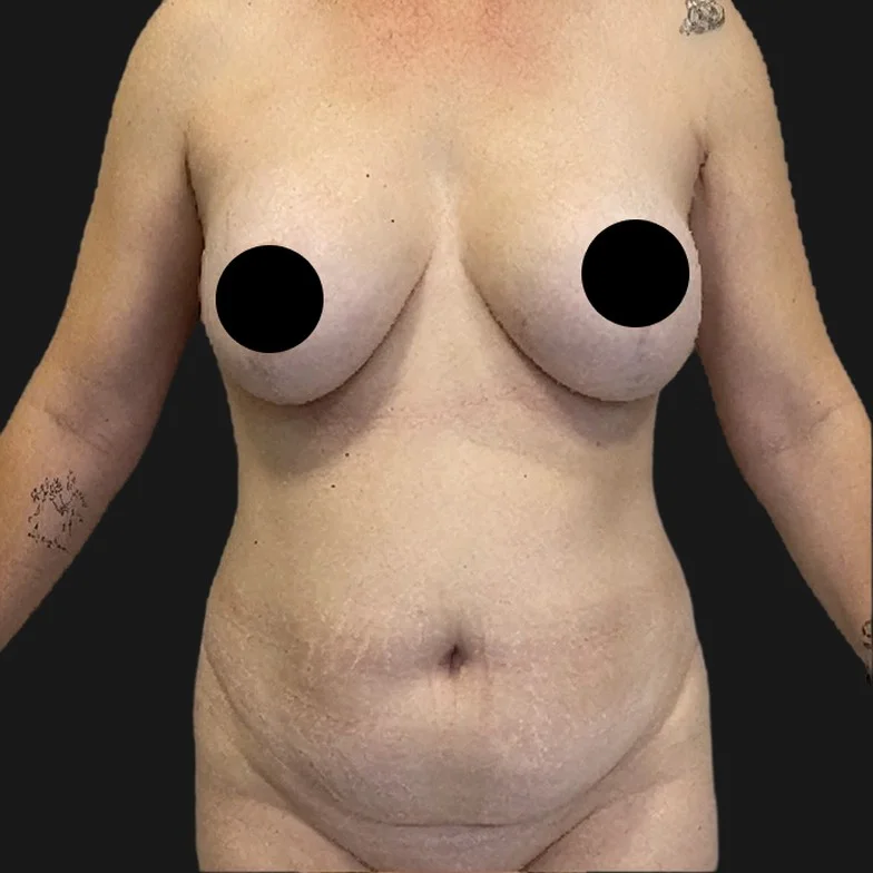 Resultado de abdominoplastia clássica — antes