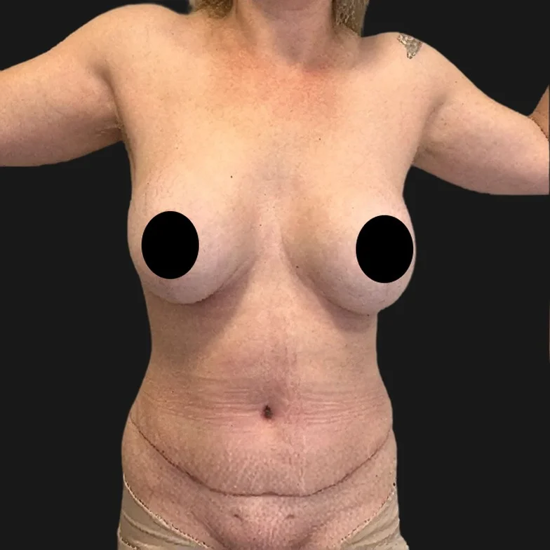 Resultado de abdominoplastia clássica — depois