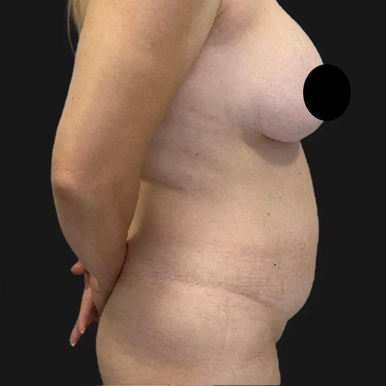 Resultado de abdominoplastia clássica — antes