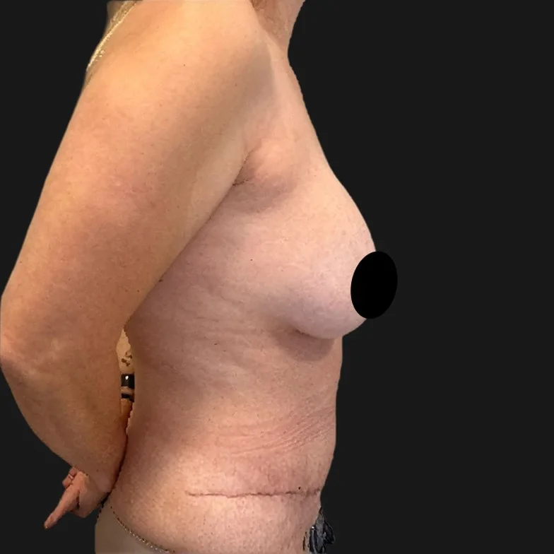 Resultado de abdominoplastia clássica — depois