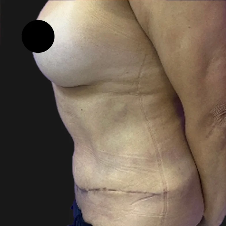 Resultado de abdominoplastia clássica — depois