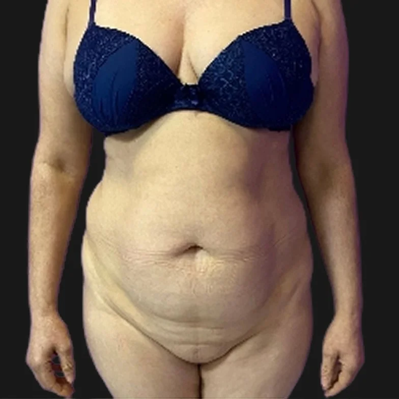 Resultado de abdominoplastia clássica — antes