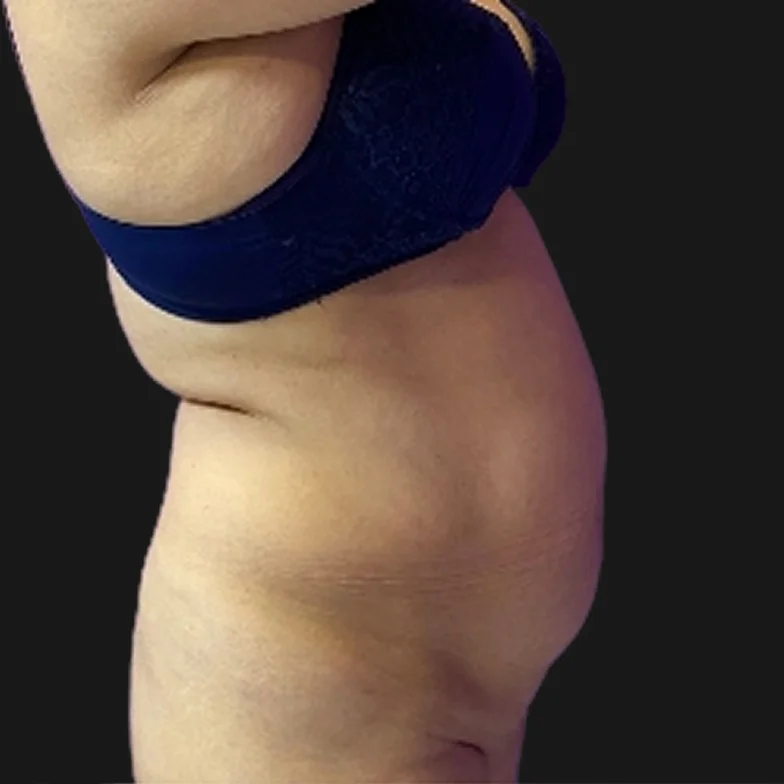 Resultado de abdominoplastia clássica — antes