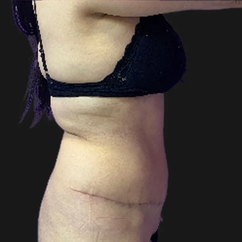 Resultado de abdominoplastia clássica — depois