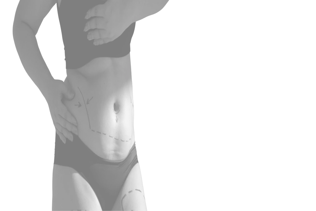 Paciente após lipoabdominoplastia, com contorno corporal definido