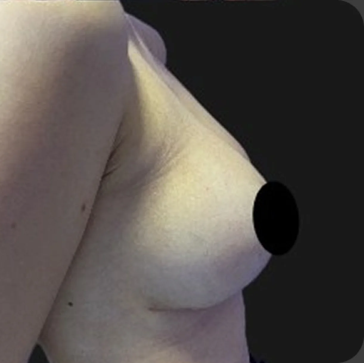 Resultado de mamoplastia redutora — depois