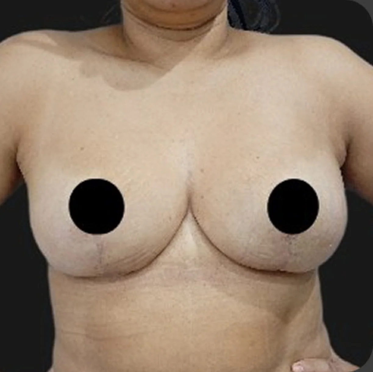 Resultado de mamoplastia redutora — depois
