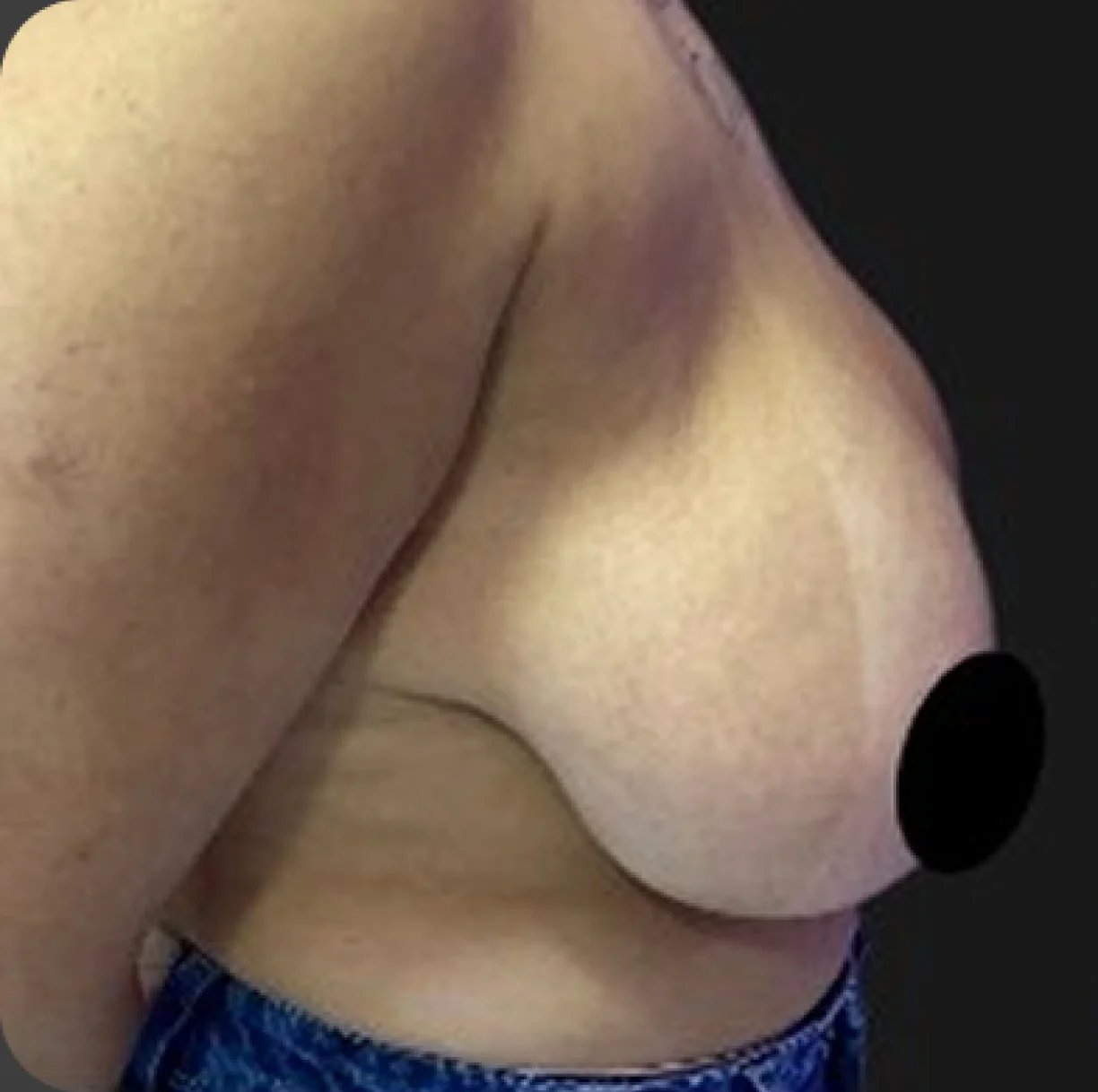 Resultado de mamoplastia redutora — antes