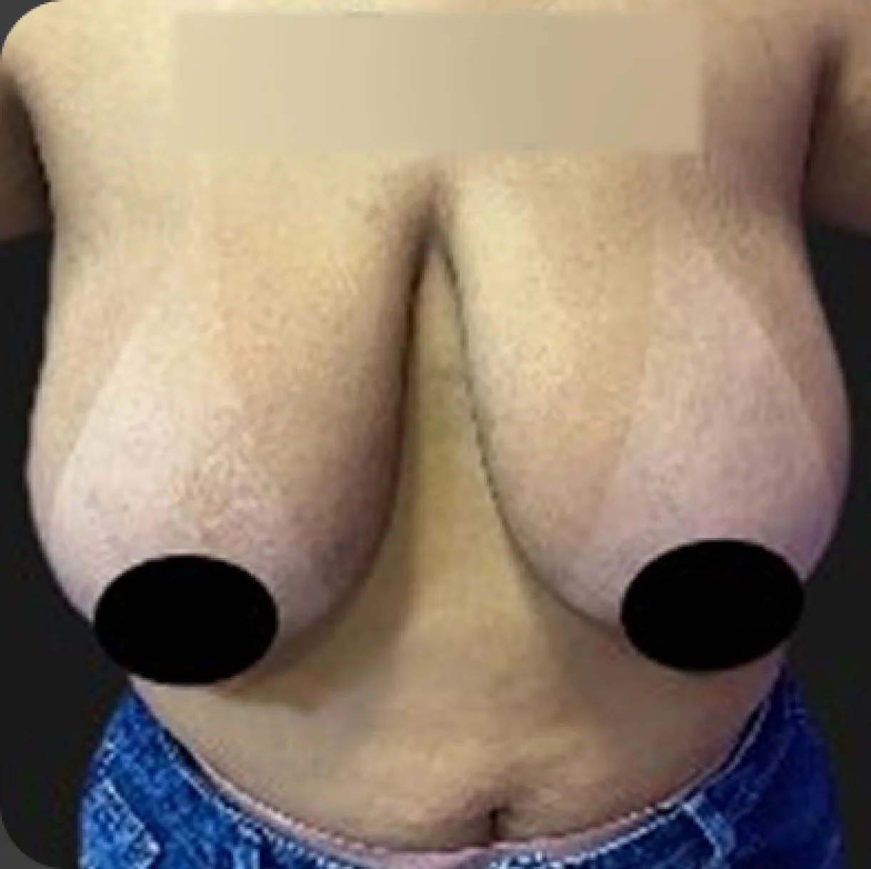 Resultado de redução de mamas — antes