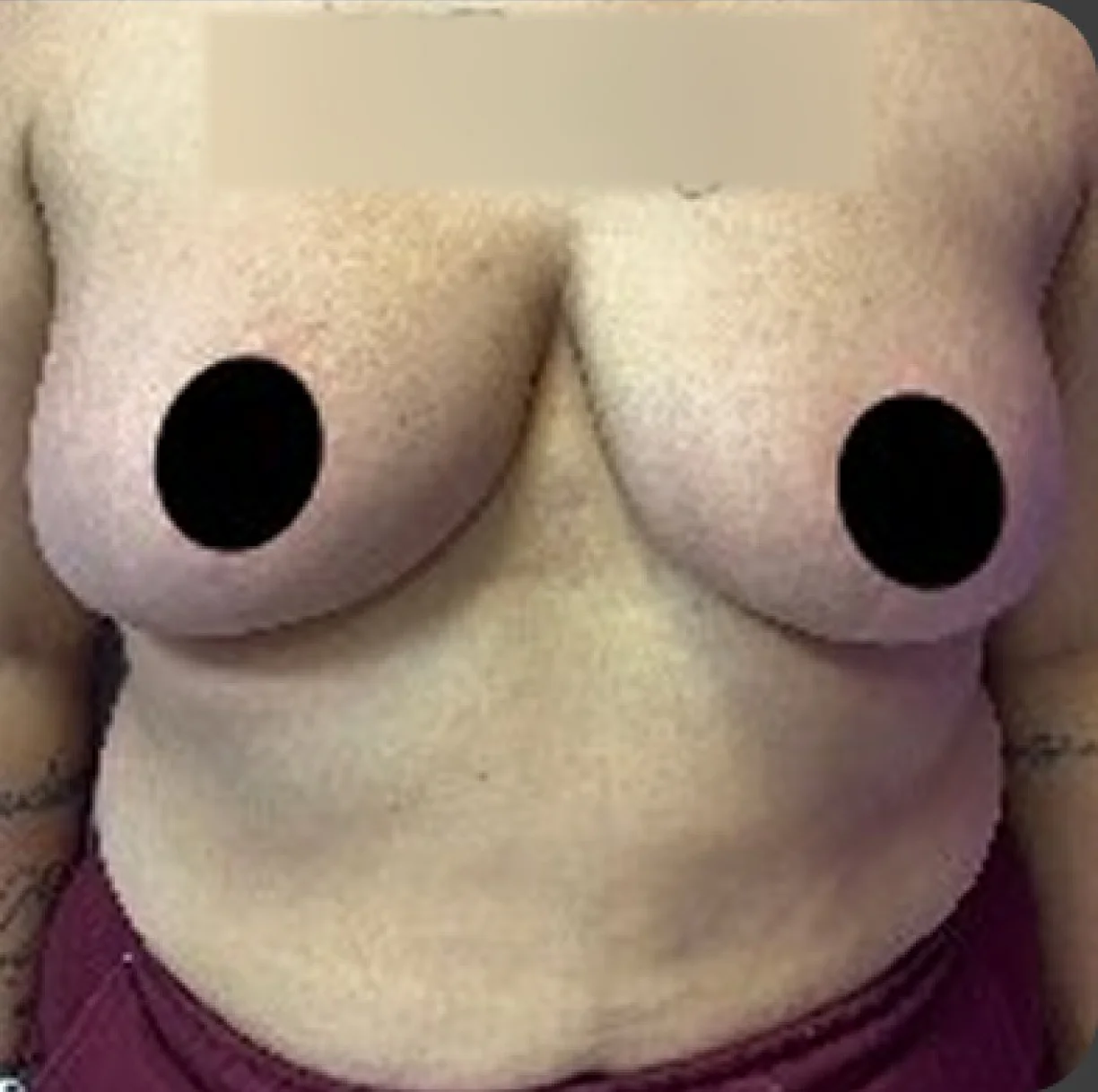 Resultado de redução de mamas — depois