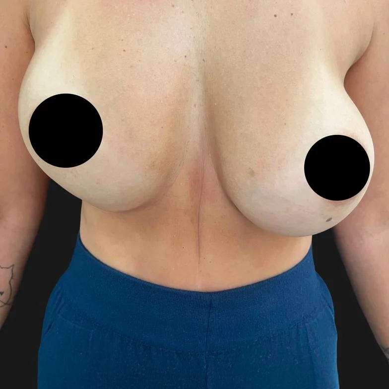 Resultado de mastopexia com prótese — antes