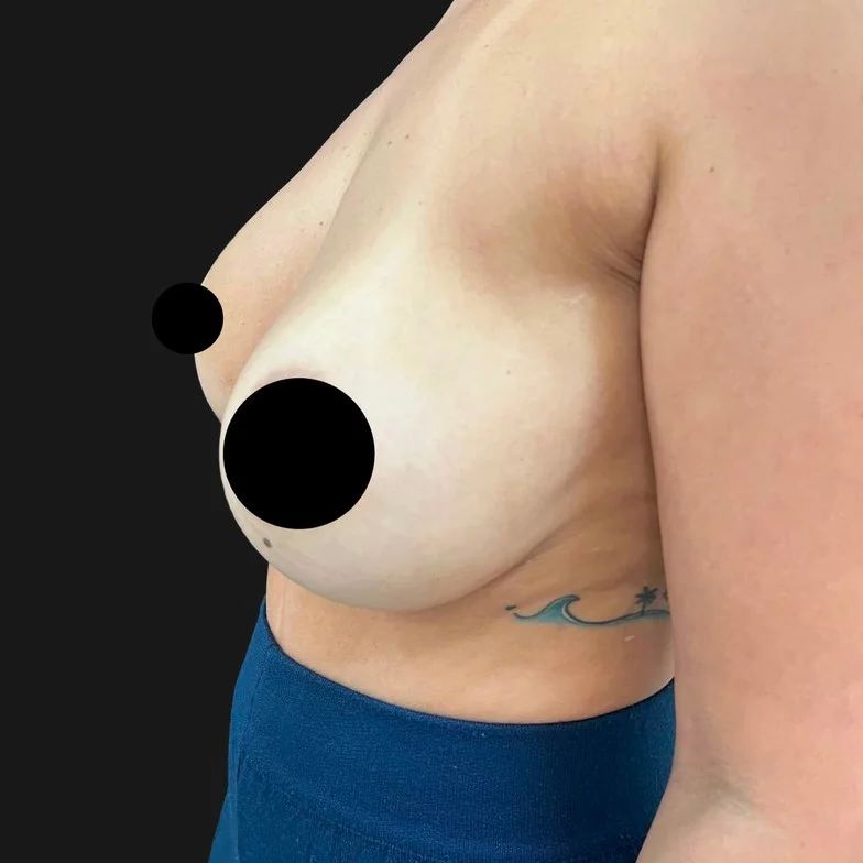 Resultado de mastopexia com prótese — antes