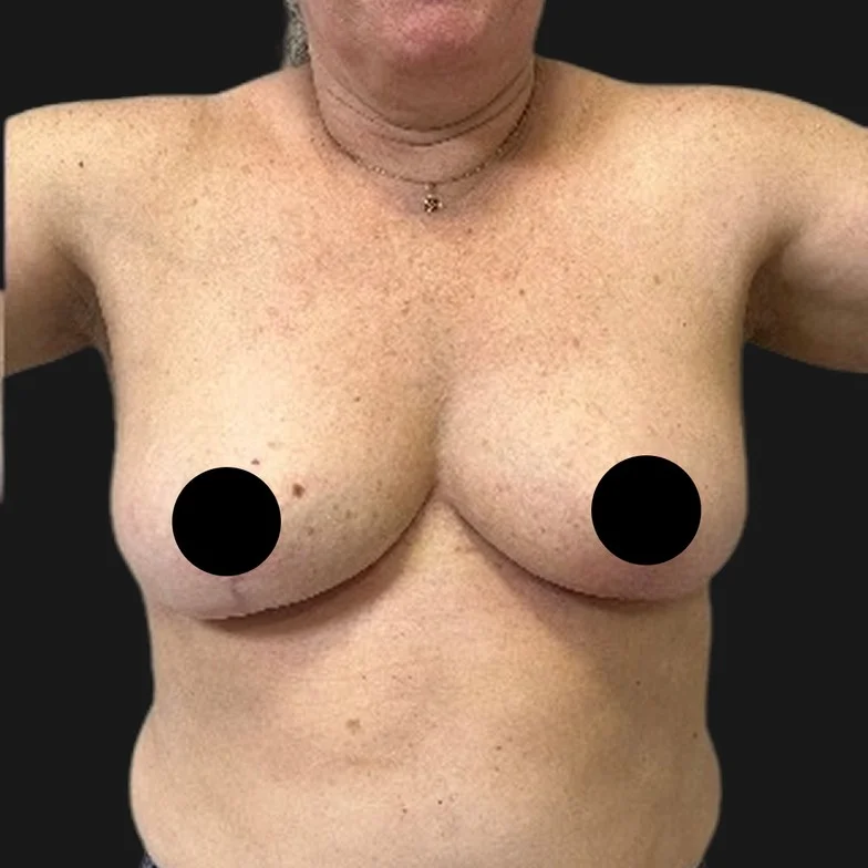 Resultado de mastopexia sem prótese — depois
