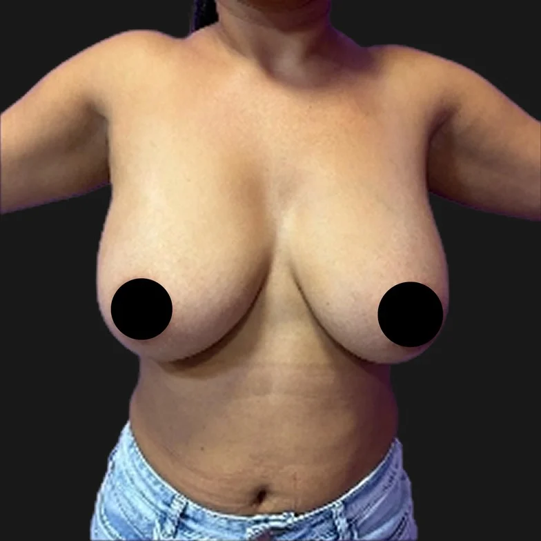 Resultado de mastopexia sem prótese — antes