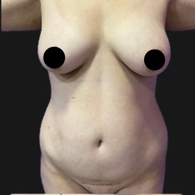 Resultado de mastopexia sem prótese — antes