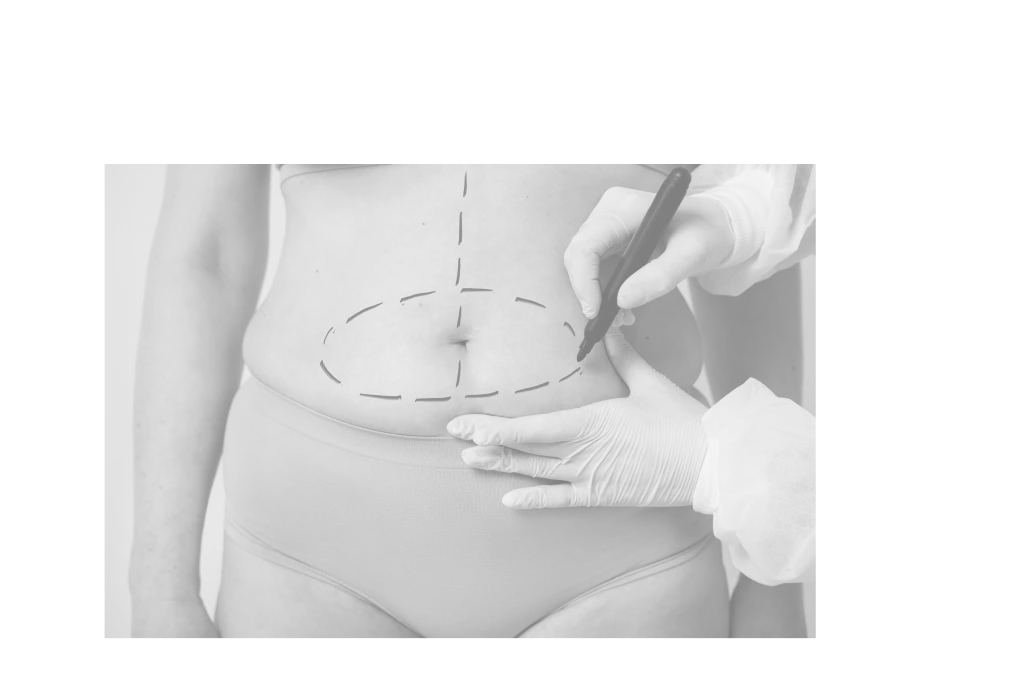 Paciente após miniabdominoplastia, abdômen inferior tratado