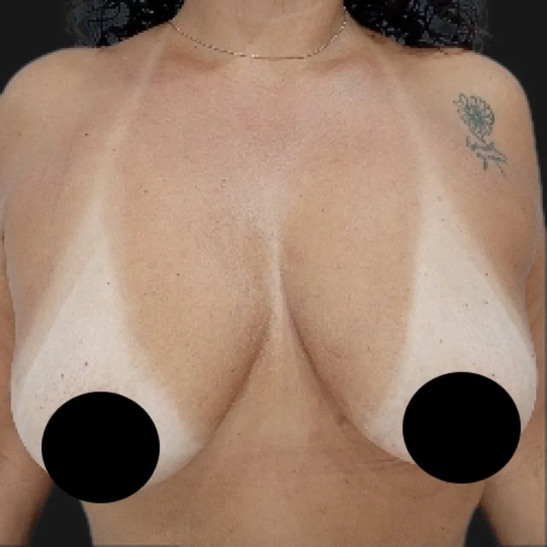 Resultado de prótese de silicone — antes