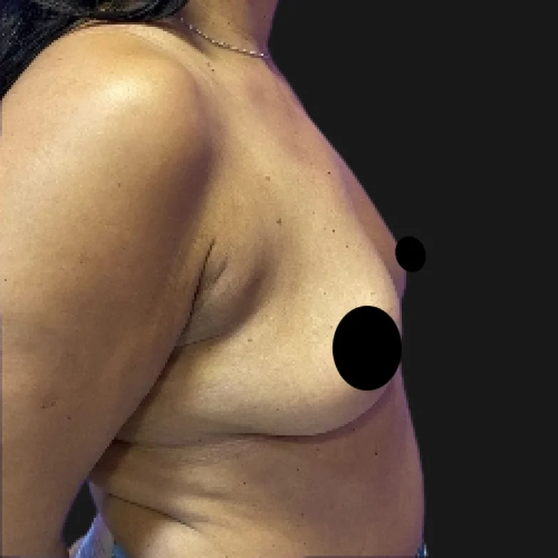 Resultado de prótese de silicone — antes