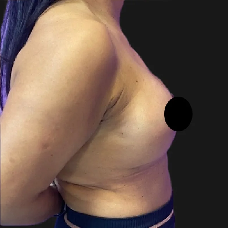 Resultado de prótese de silicone — depois