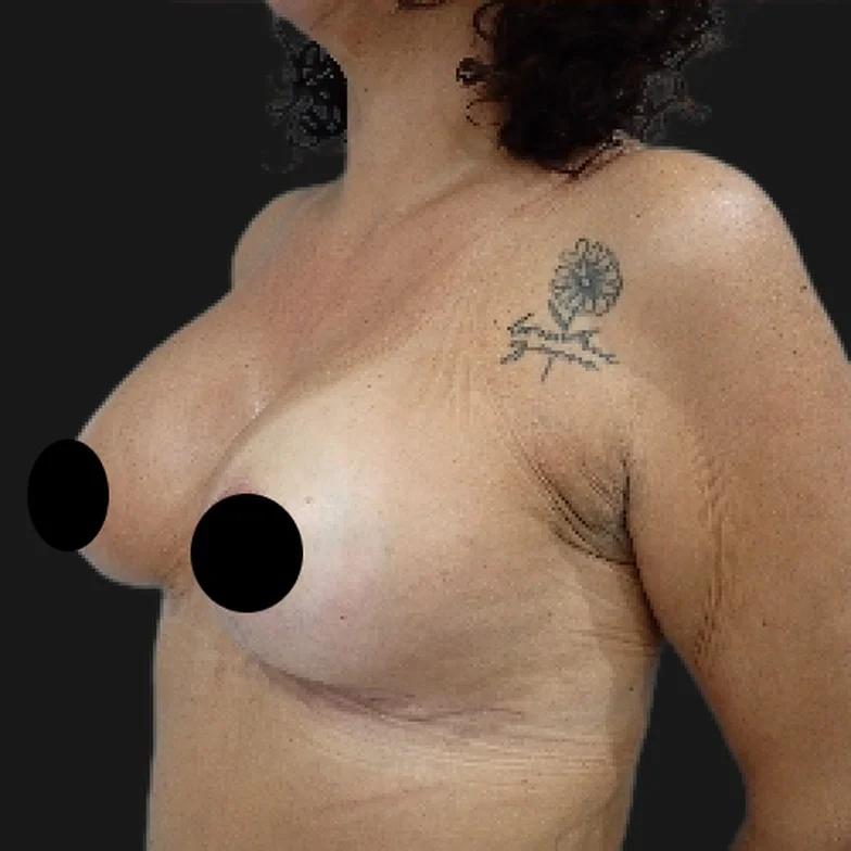 Resultado de prótese de silicone — depois