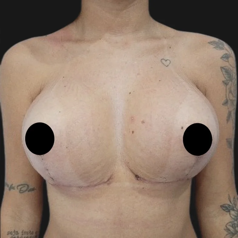 Resultado de prótese de silicone — depois