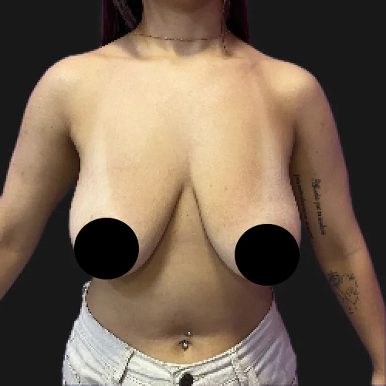 Resultado de prótese de silicone — antes