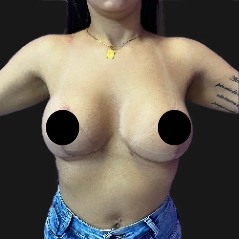 Resultado de prótese de silicone — depois