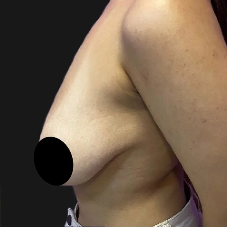 Resultado de prótese de silicone — antes