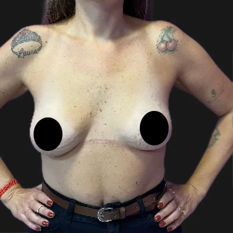 Resultado de prótese de silicone — antes