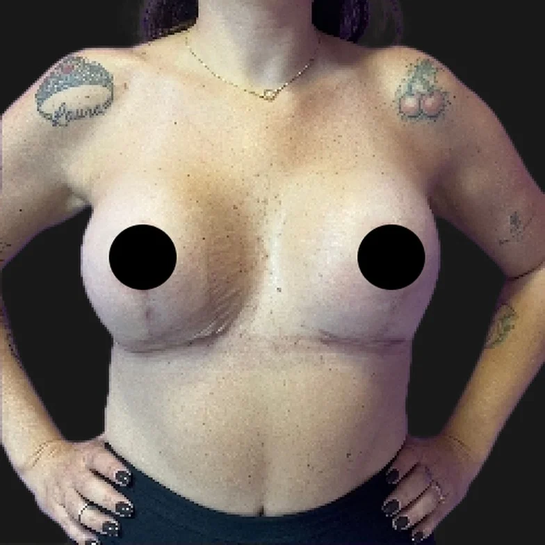 Resultado de prótese de silicone — depois