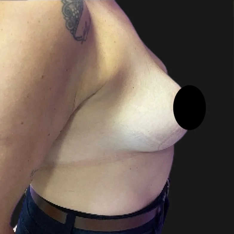 Resultado de prótese de silicone — antes