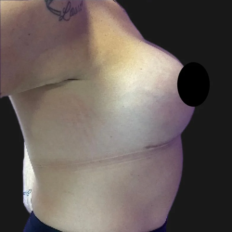 Resultado de prótese de silicone — depois