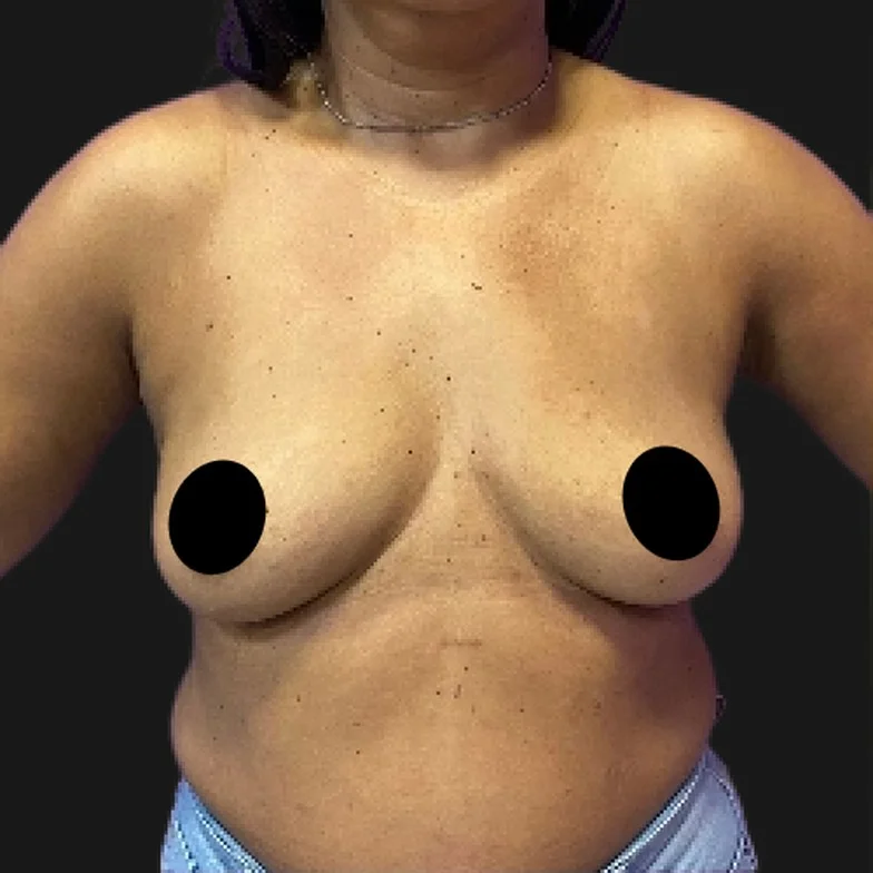 Resultado de prótese de silicone — antes