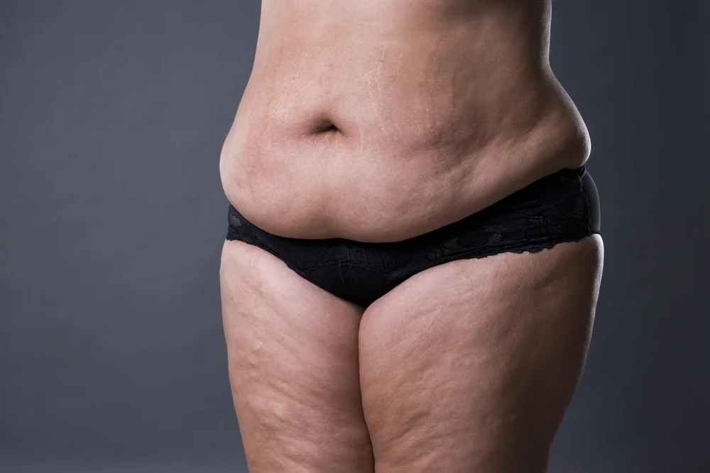 Resultado de abdominoplastia de barriga de avental