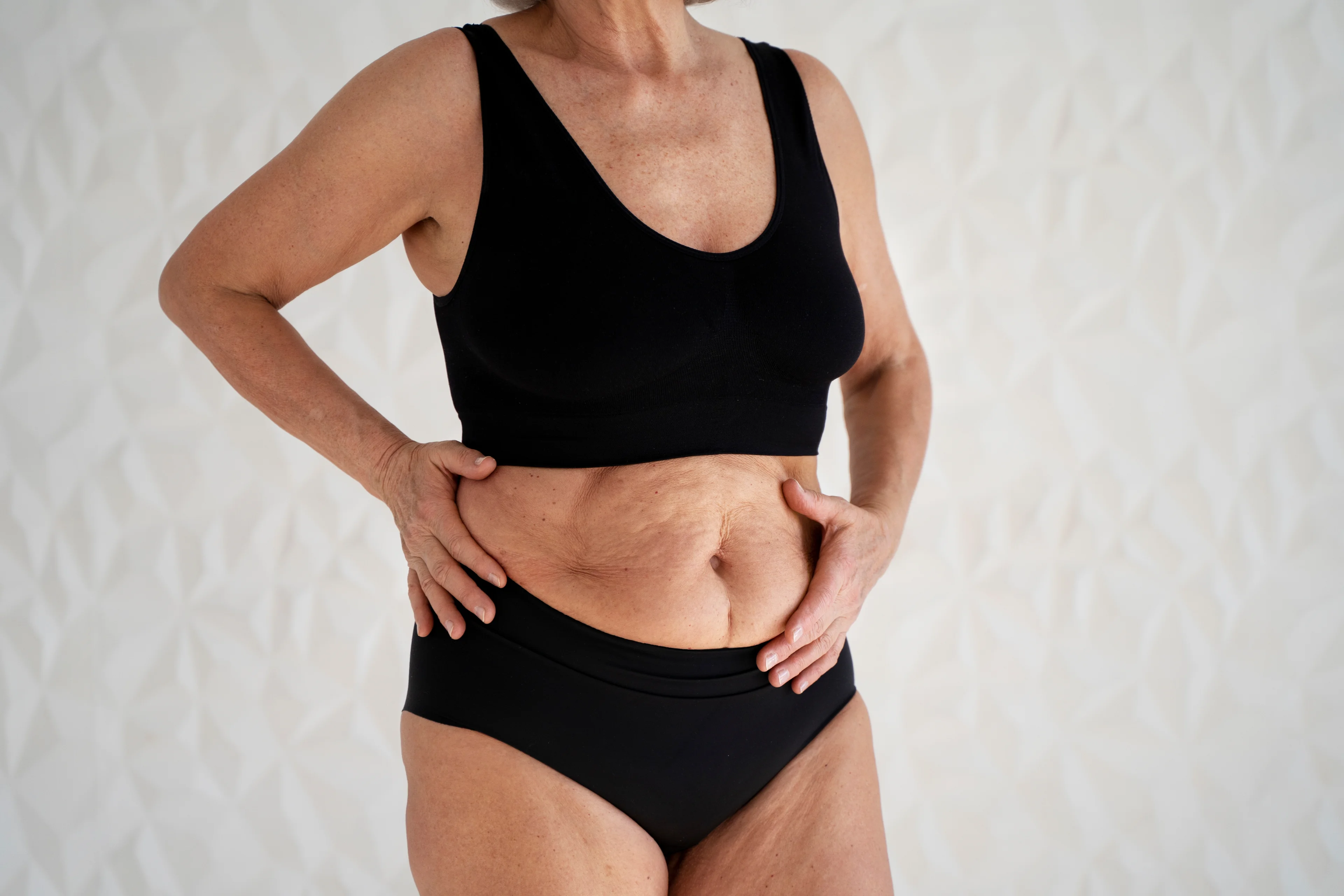 Resultado de abdominoplastia clássica